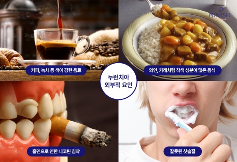 Yellowed Teeth and Discoloration: From the Cause to the Right Improvement Method for Me image 2