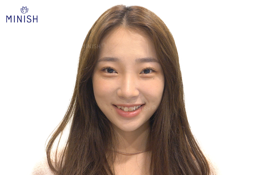 치아 콤플렉스? 치아성형 대신 미니쉬 관련 이미지 2
