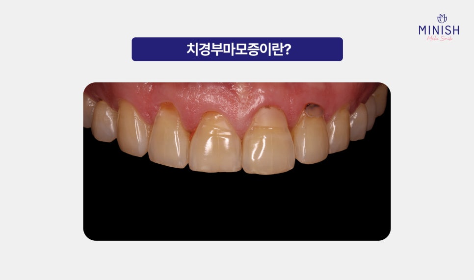 Relieve Tooth Sensitivity Caused by Cervical Abrasion with Pink Minishe image 2