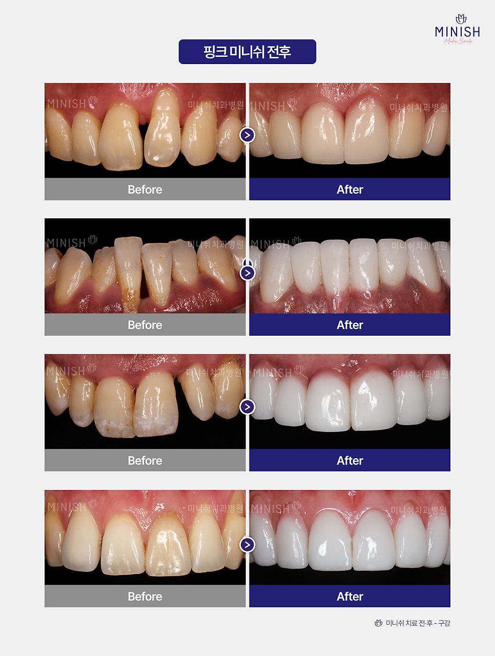 Swollen Gums and Bleeding? Warning Signs of Periodontal Disease image 7