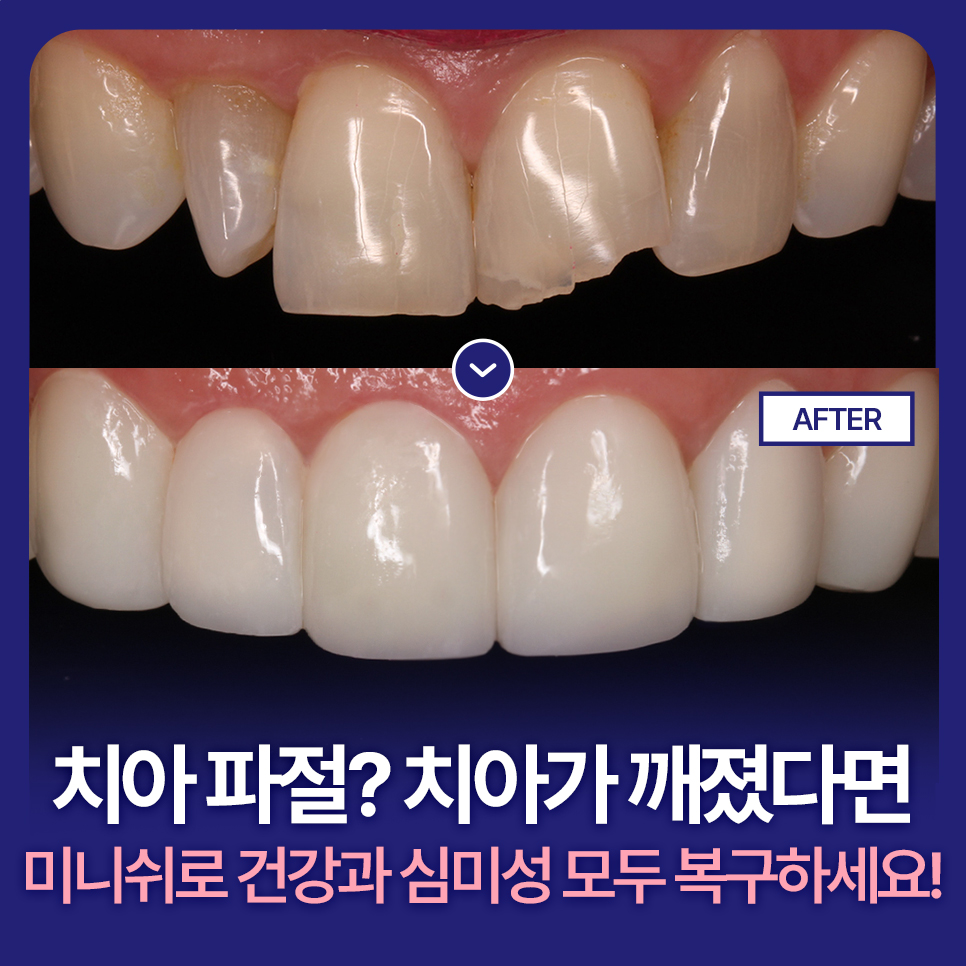 치아 파절? 치아가 깨졌다면 미니쉬로 건강과 심미성을 모두 복구하세요! 관련 이미지 1