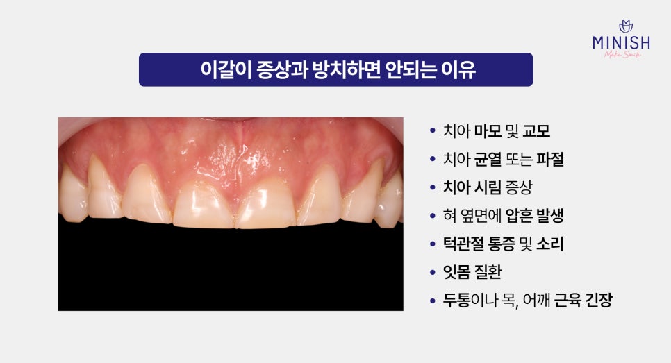 If you leave teeth grinding untreated, it can even cause tooth cracks image 3