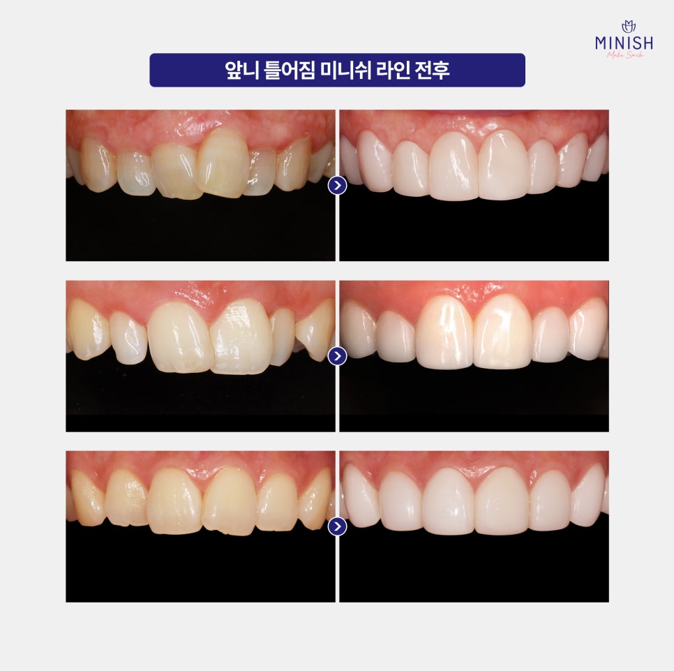 What Problems Can Crooked Front Teeth Cause If Left Untreated, and What Are the Fast Ways to Improve Them? image 5