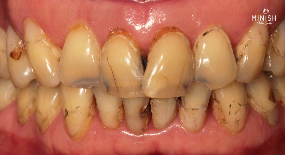 Why Choose Minish Instead of Crowns for Tooth Erosion After Overcoming Cancer? image 4