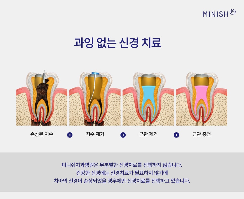 충치 단계별 치료 방법, 원데이 치료로 하루 만에 가능할까? 관련 이미지 7