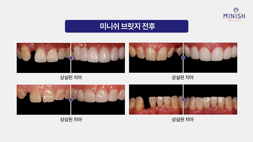 From Front Teeth to Molars, Which Minish Is Right for My Dental Condition? image 11