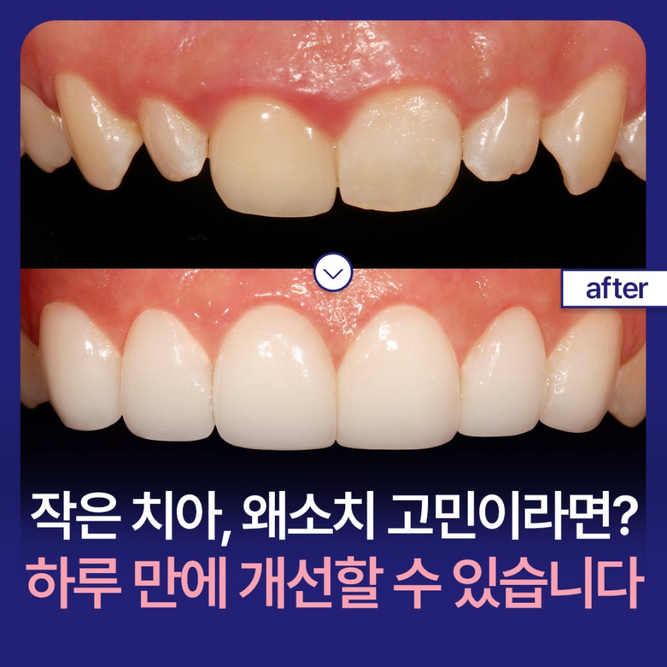 작은 치아, 왜소치 고민이라면? 하루 만에 개선할 수 있습니다 관련 이미지 1
