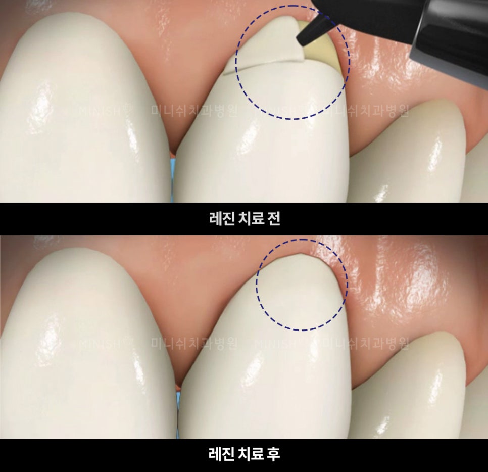 이가 시린 이유와 시린이 해결 방법 관련 이미지 5