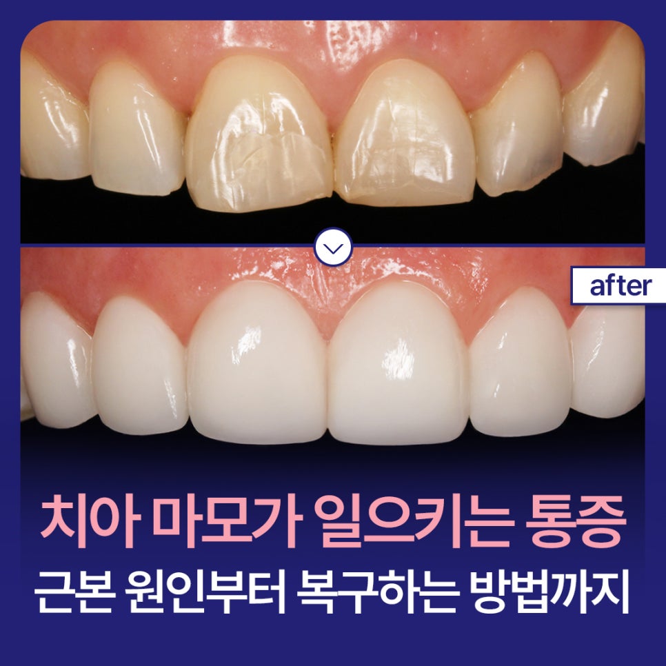 Pain Caused by Tooth Wear: From the Root Causes to Recovery Methods image 1