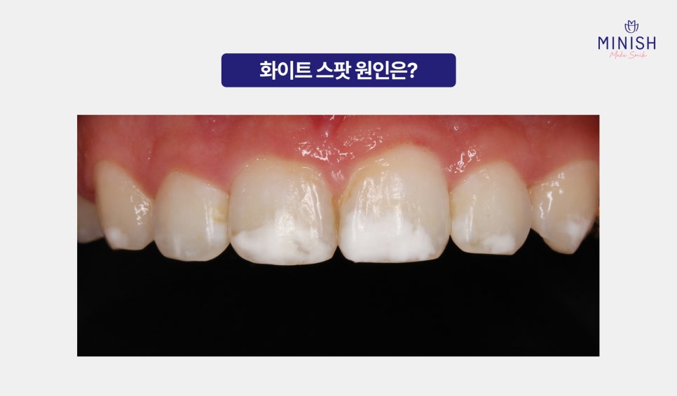 White Spots: Improve Stained Teeth Naturally with Minish! image 2