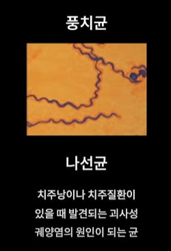 잇몸염증은 구강 적신호...가장 적극적인 잇몸치료는 미니쉬 관련 이미지 5