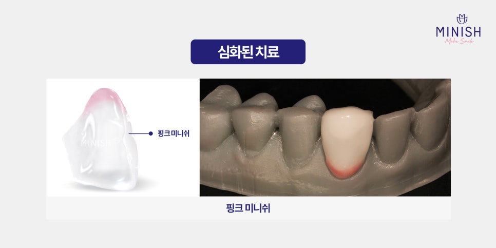 잇몸 부음, 방치하면 큰일! 원인과 치료법 알아보기 관련 이미지 7