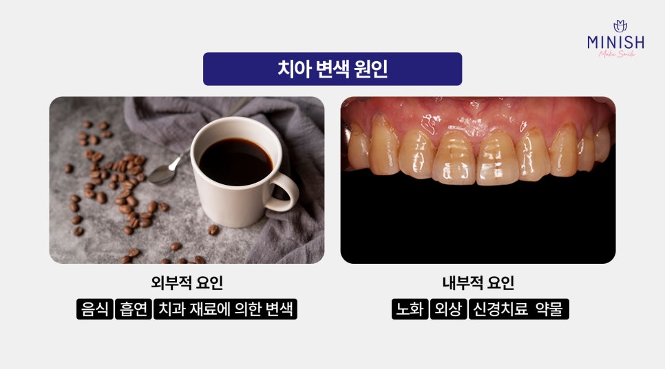 Yellow Teeth Concerns: Teeth Whitening Methods That Vary by Cause image 2
