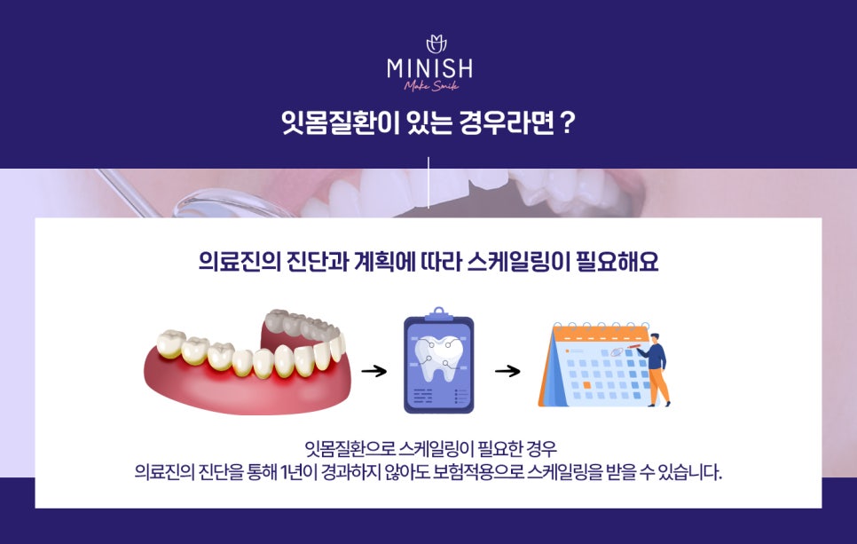 스케일링 주기, 1년에 몇 번 하는게 좋을까? 관련 이미지 5