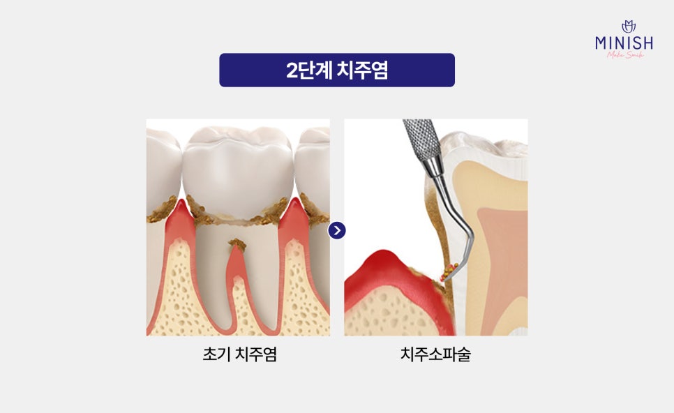 Bad Breath Causes: Could They Be More Serious Than You Think? A Summary of Solutions! image 6