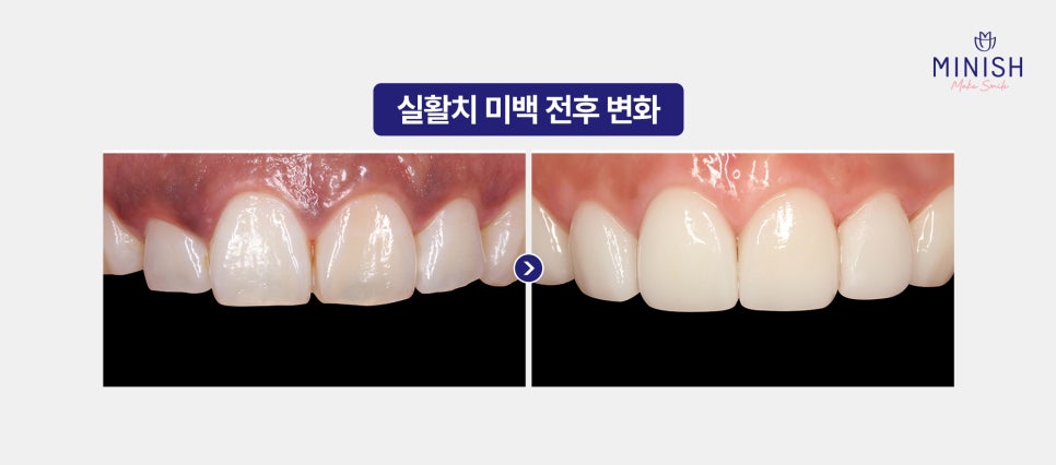 Yellow Teeth Concerns: Teeth Whitening Methods That Vary by Cause image 16