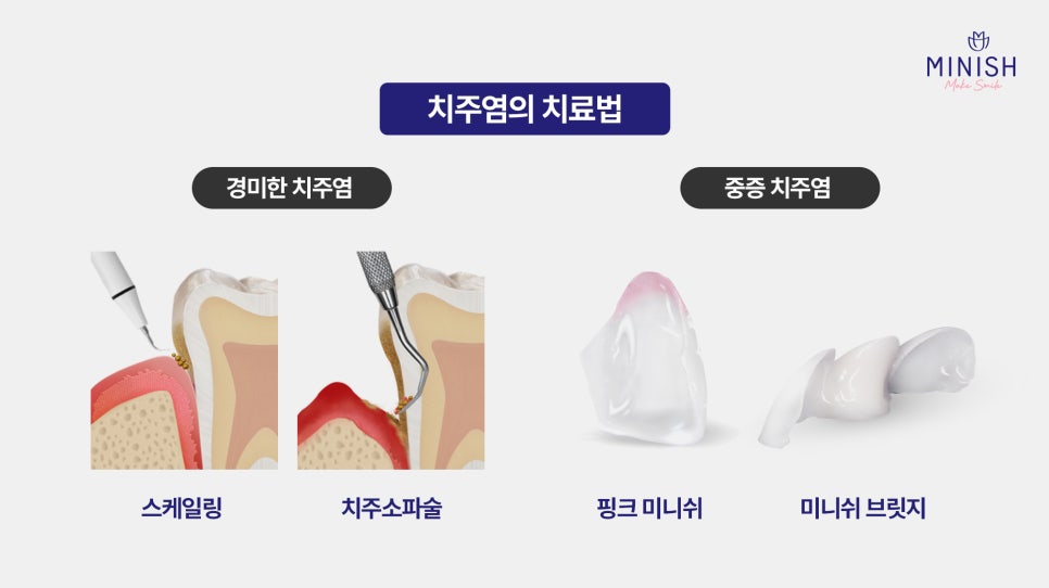 치주염 치료, 미니쉬가 제안하는 건강한 치아복구 솔루션 관련 이미지 6