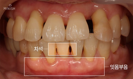 안성엄마와 딸을 괴롭힌 잇몸병 [엄마는예뻤다] 관련 이미지 5
