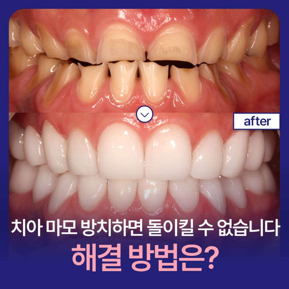 If You Leave Tooth Wear Untreated, It Becomes Irreversible. What Is the Solution? image 1