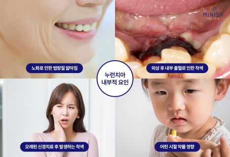 Yellowed Teeth and Discoloration: From the Cause to the Right Improvement Method for Me image 3