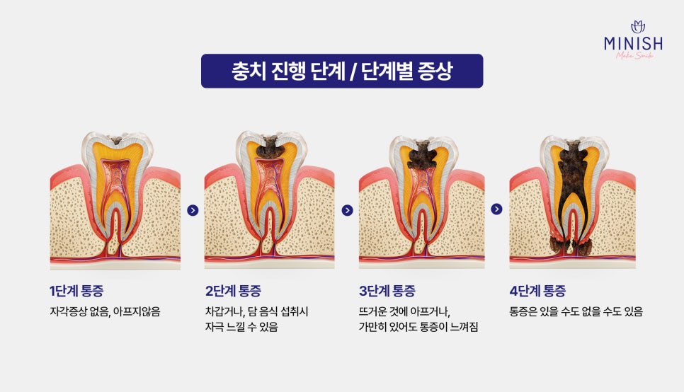 Caused by Cavities? A Complete Guide to Why Molars Break and How to Treat Them image 3