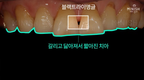 [Tooth Aging] Do Teeth Age, Too? Restoring Them Healthily with Minishe image 4