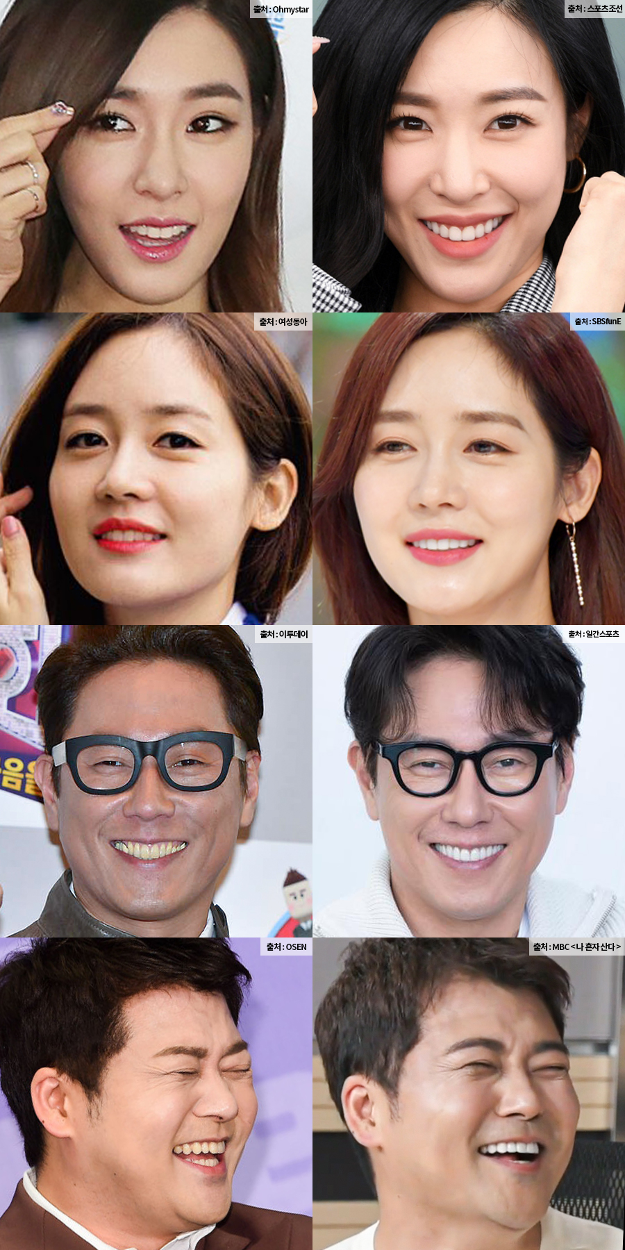 누런니 고민은 치과 치아미백 아닌 원데이미니쉬 관련 이미지 9