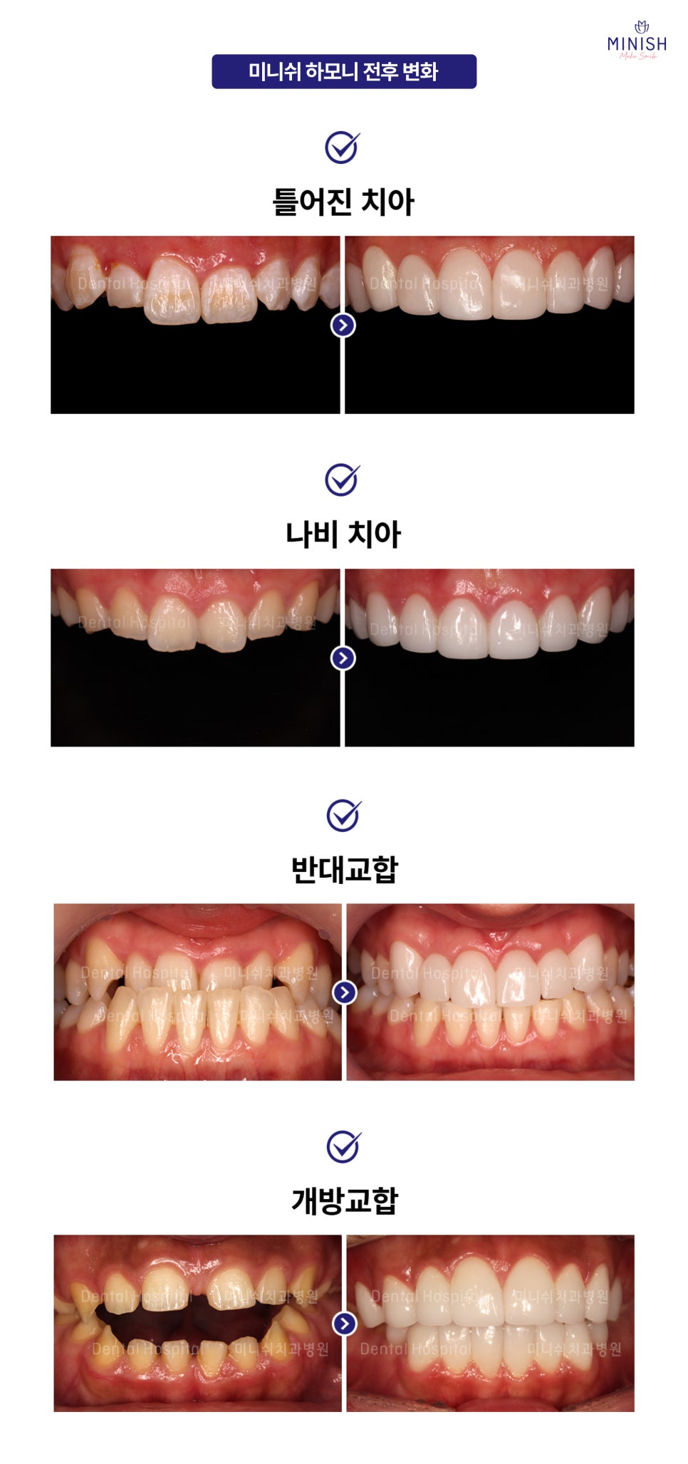 A Complete Guide to the Minish Program That Fits My Teeth image 14