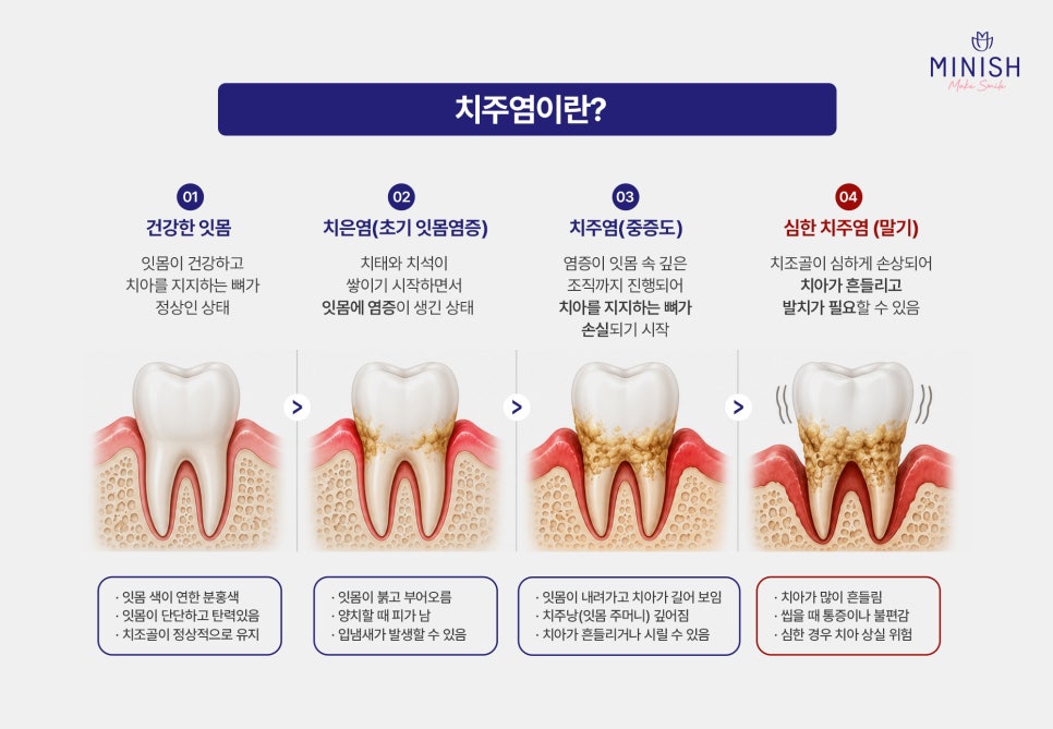 급성 치수염 VS 치주염 원인, 증상, 치료 방법까지 관련 이미지 4