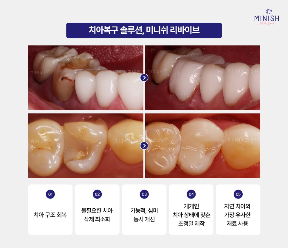 What Happens If You Leave a Fallen Crown Alone? Why You Need to Visit the Dentist Right Away image 5