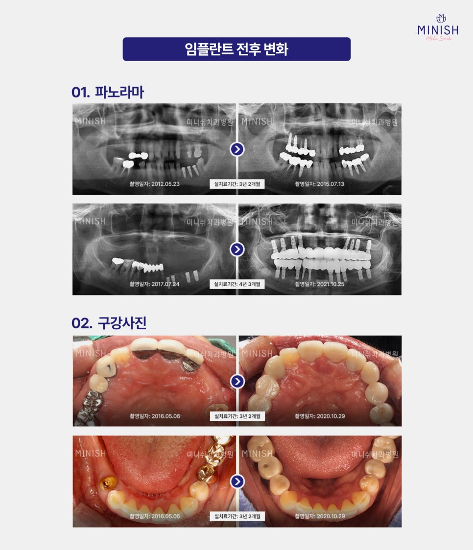 Implants, Only When Truly Necessary! Minish Dental Hospital’s Treatment Process for Protecting Natural Teeth image 11