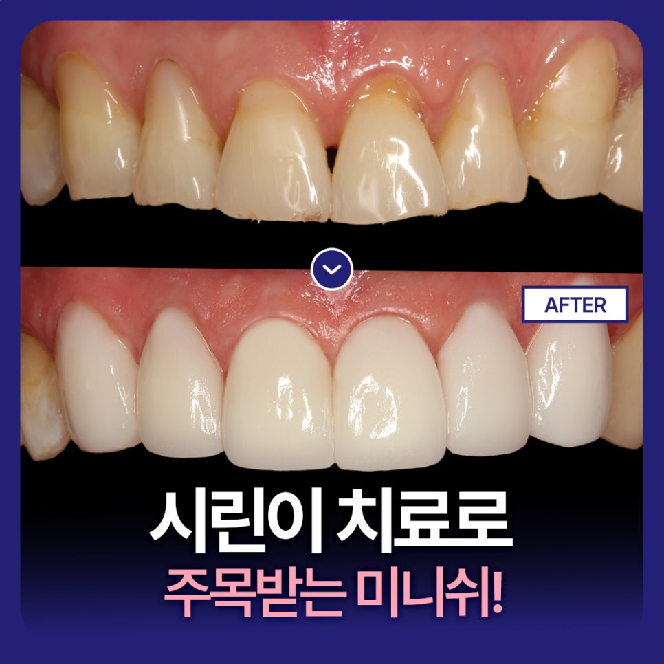 시린이 치료로 주목받는 미니쉬! 관련 이미지 1