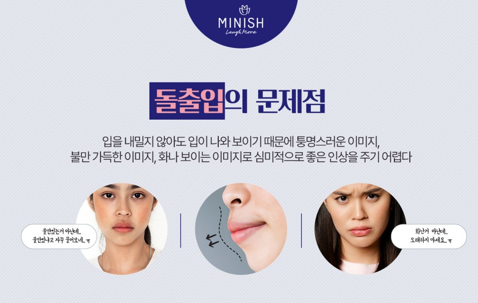 돌출입교정, 빠르게 치아의 비율까지 교정한다? 관련 이미지 4
