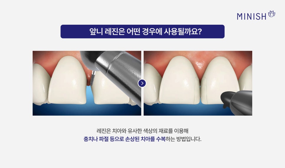 Understanding Discolored Resin on Front Teeth, from Causes to Retreatment image 2