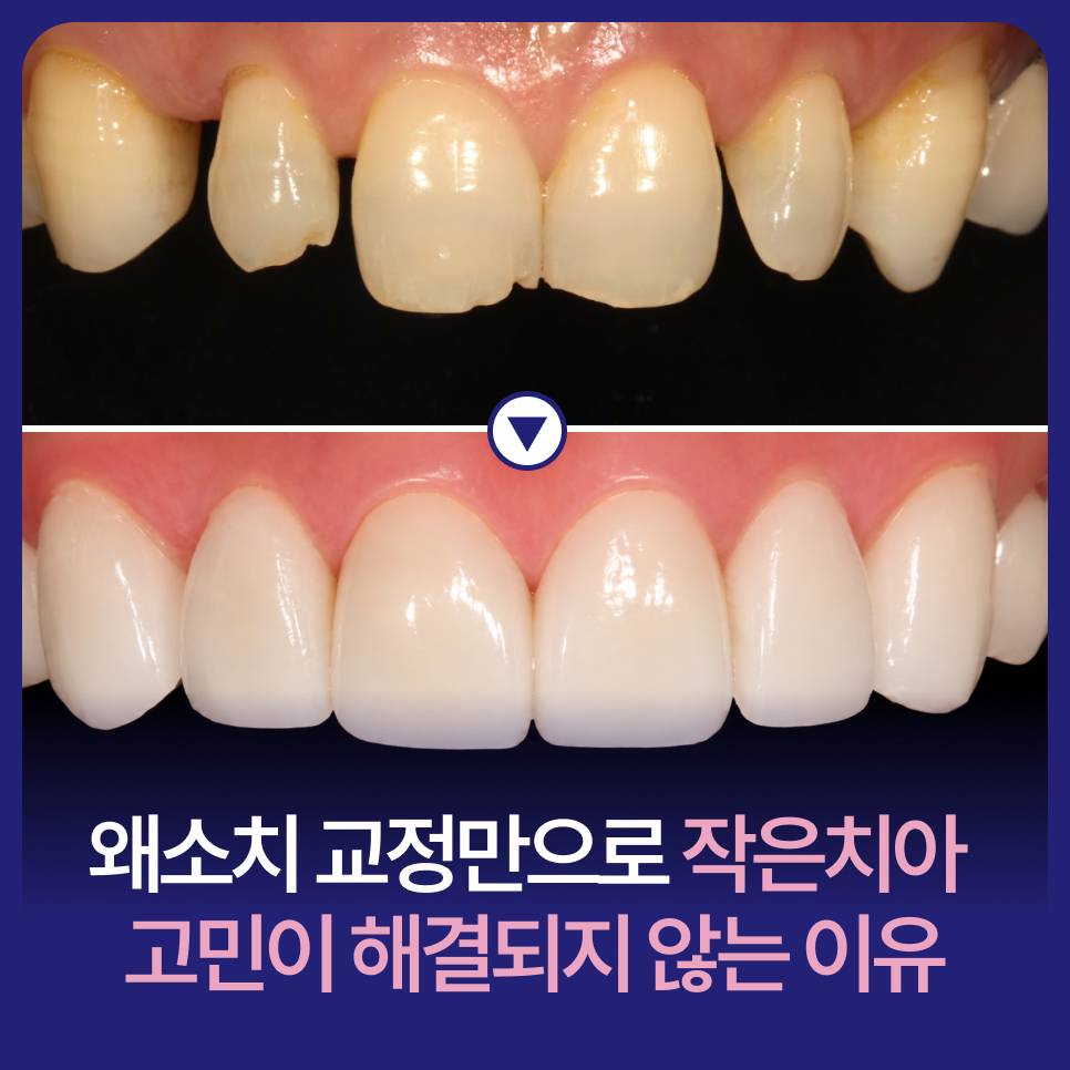 왜소치 교정만으로 작은치아 고민이 해결되지 않을 땐? 미니쉬 심플 관련 이미지 1