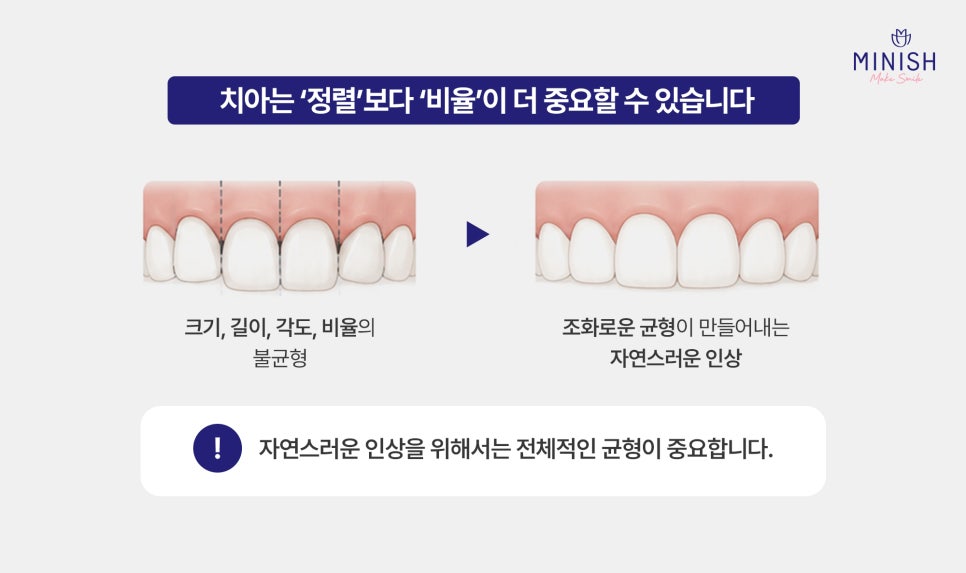 Crooked Front Teeth and the Butterfly Teeth Complex: Why Improving Tooth Shape and Proportions Matters / Minish Line image 4