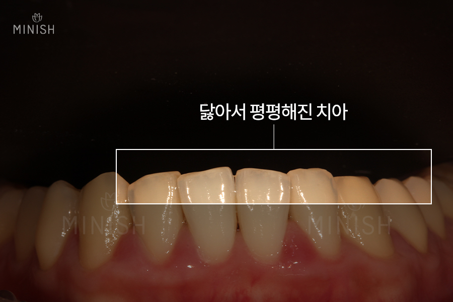 안성엄마와 딸을 괴롭힌 잇몸병 [엄마는예뻤다] 관련 이미지 13