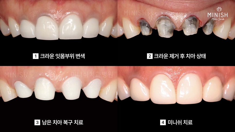 앞니 크라운 재치료가 필요하다면? 미니쉬로 건강하게 복구하세요 관련 이미지 5