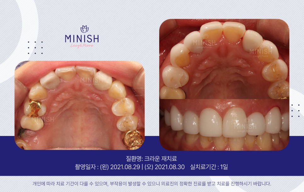 오래된 크라운 재치료가 시급하다면, 미니쉬치과 관련 이미지 5