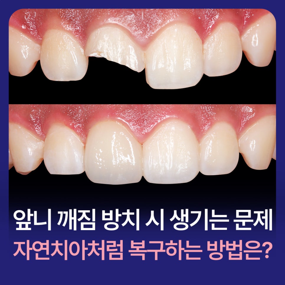 What Problems Can Occur If a Chipped Front Tooth Is Left Untreated, and How Can It Be Restored to Look Like a Natural Tooth? image 1