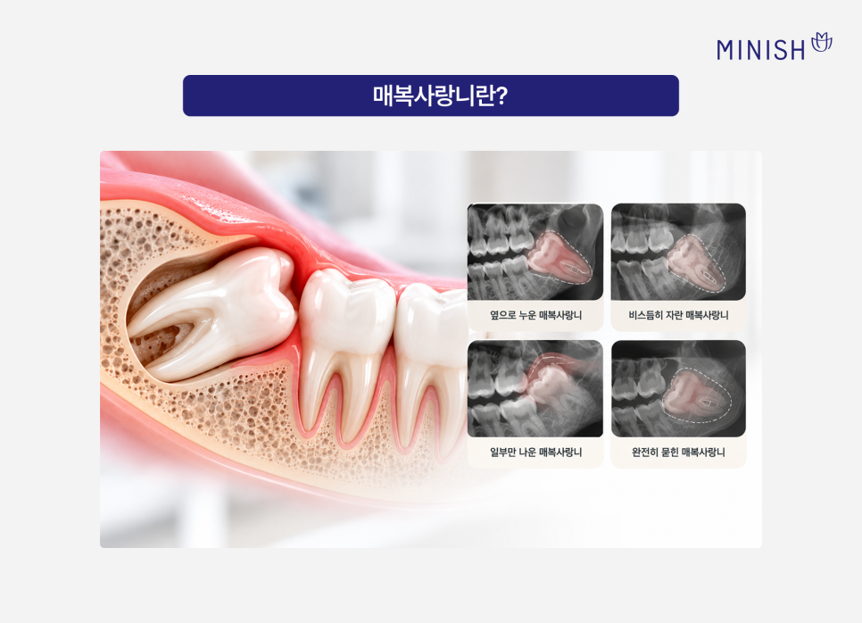 매복사랑니 통증, 발치 꼭 해야 하나요? 관련 이미지 2