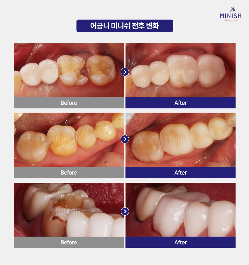 어금니 크라운 통증·깨짐·빠짐·교체, 재치료 고민이라면 어금니 미니쉬 관련 이미지 6