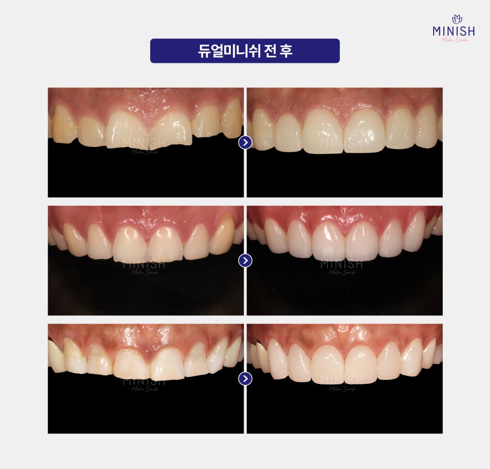 If You Leave Tooth Wear Untreated, It Becomes Irreversible. What Is the Solution? image 6
