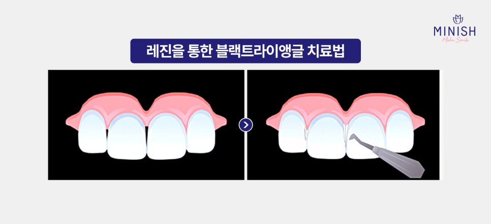 블랙트라이앵글 원인과 레진, 미니쉬 해결 방법 관련 이미지 5