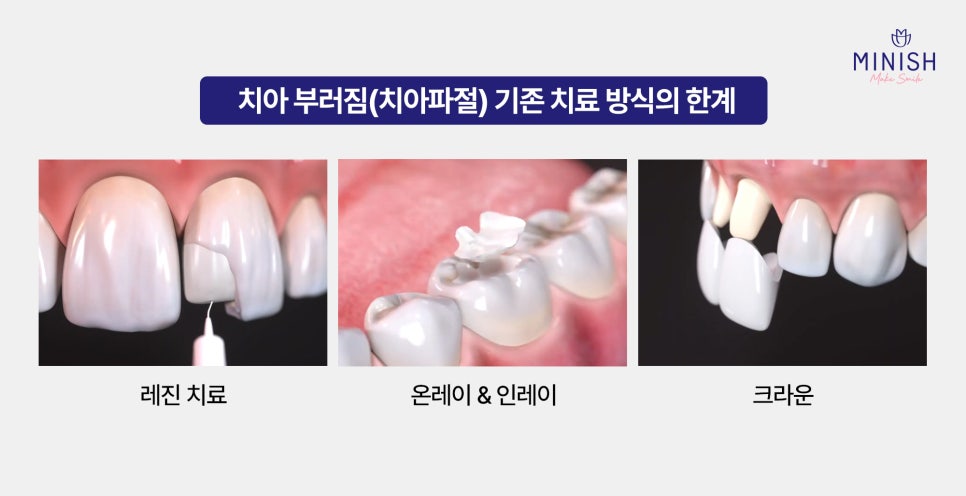 Hakdong Station Dental Clinic: Broken Teeth and Tooth Fracture Treatment — How Long Is the Golden Time? image 5