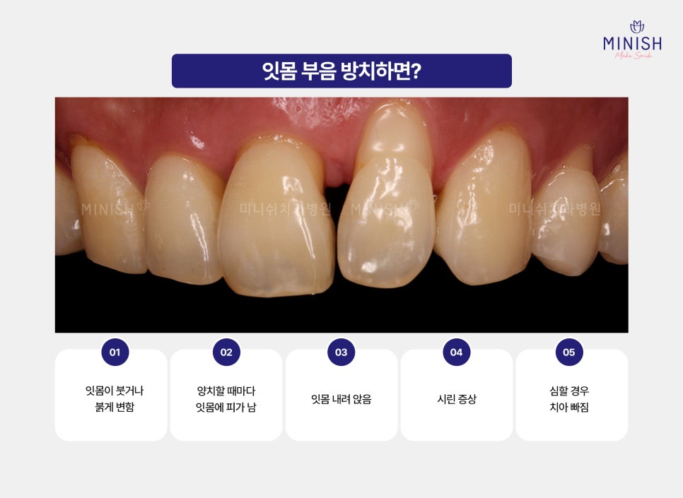 If Gum Swelling Continues, Suspect Periodontal Disease image 3