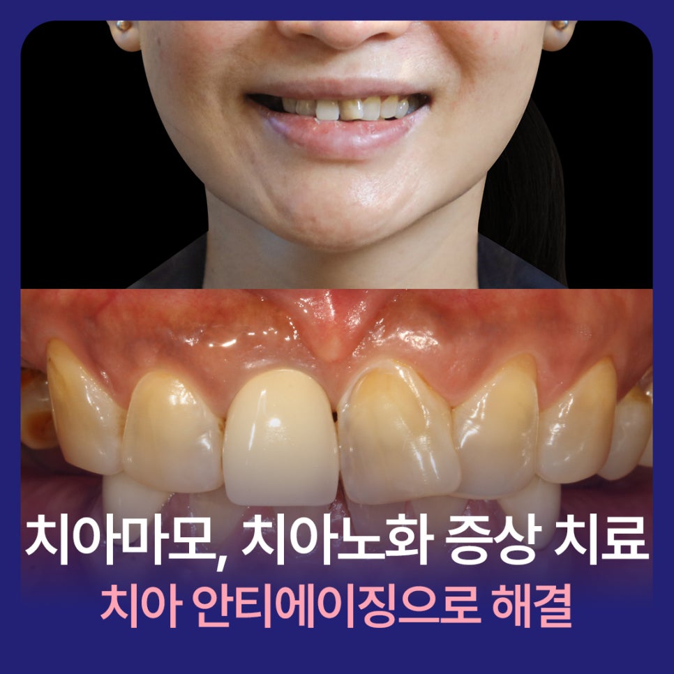 치아마모, 치아노화 증상 치료 치아 안티에이징으로 해결 관련 이미지 1