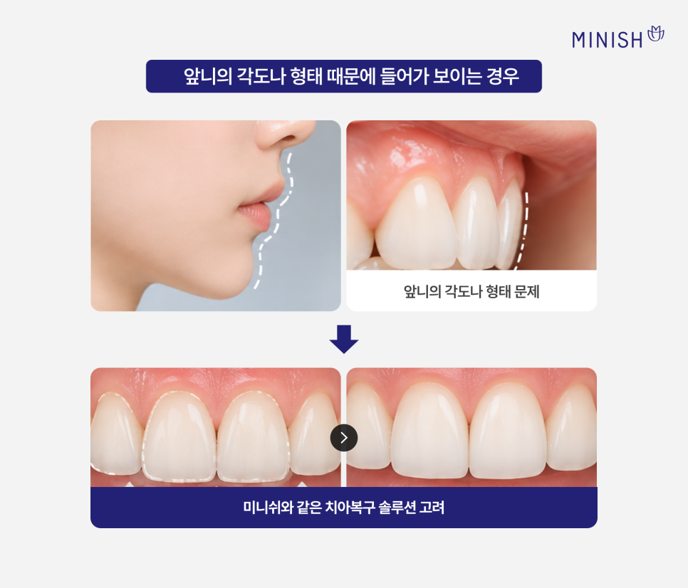 교정 후 들어간 입, 옥니 (옹니)가 고민, 미니쉬로 개선할 수 있을까? 관련 이미지 5