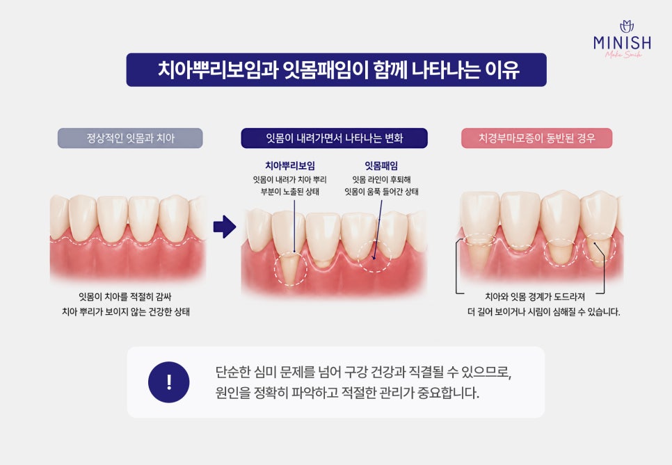 Cervical Abrasion, Causes of Exposed Tooth Roots, and Treatment for Gum Indentations image 4