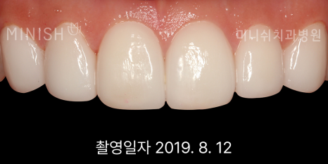 입냄새 원인 별 예방과 제거 치료 방법은? 관련 이미지 6